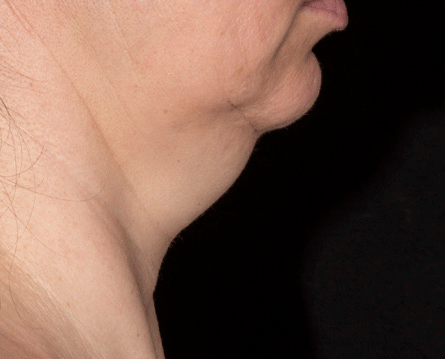 chin sculpting in kenosha, hormone therapy provider in oak creek, fat loss kenosha