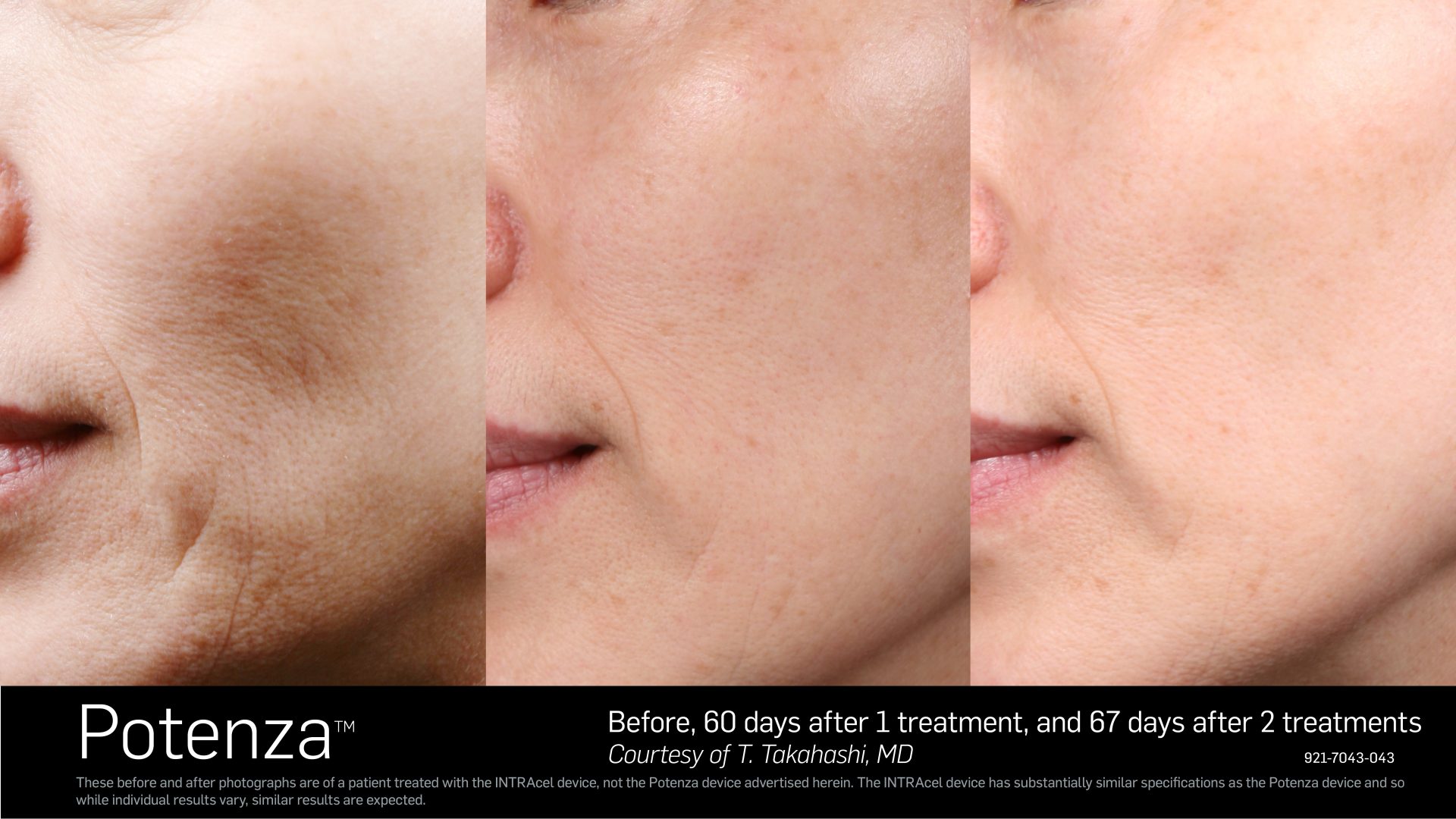 Potenza RF Microneedling Affordable Beauty
