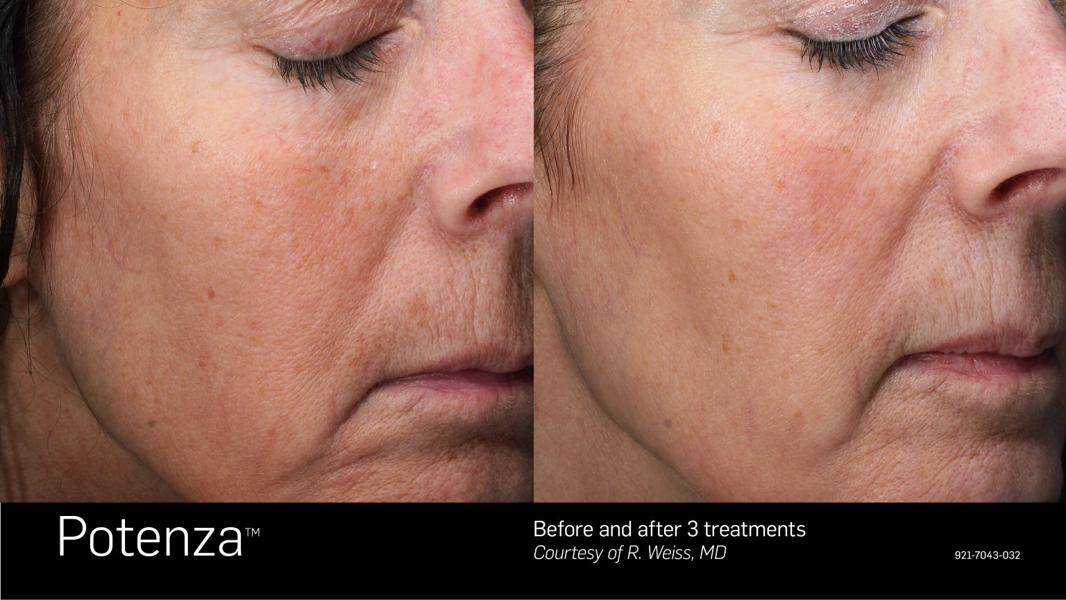 Potenza™ ~ RF Microneedling ~ Affordable Beauty