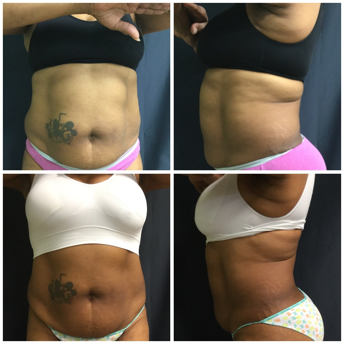 before and after treatment, weight and fat loss, fat contouring treatments